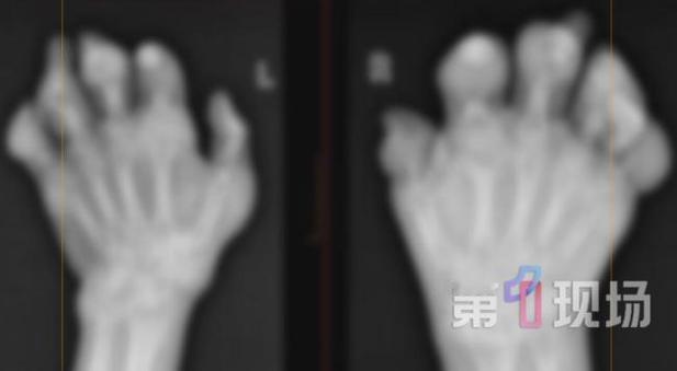 近日，深圳一名28岁男子因长期每日饮用三杯奶茶，加上熬夜、缺乏运动，身体亮起红灯