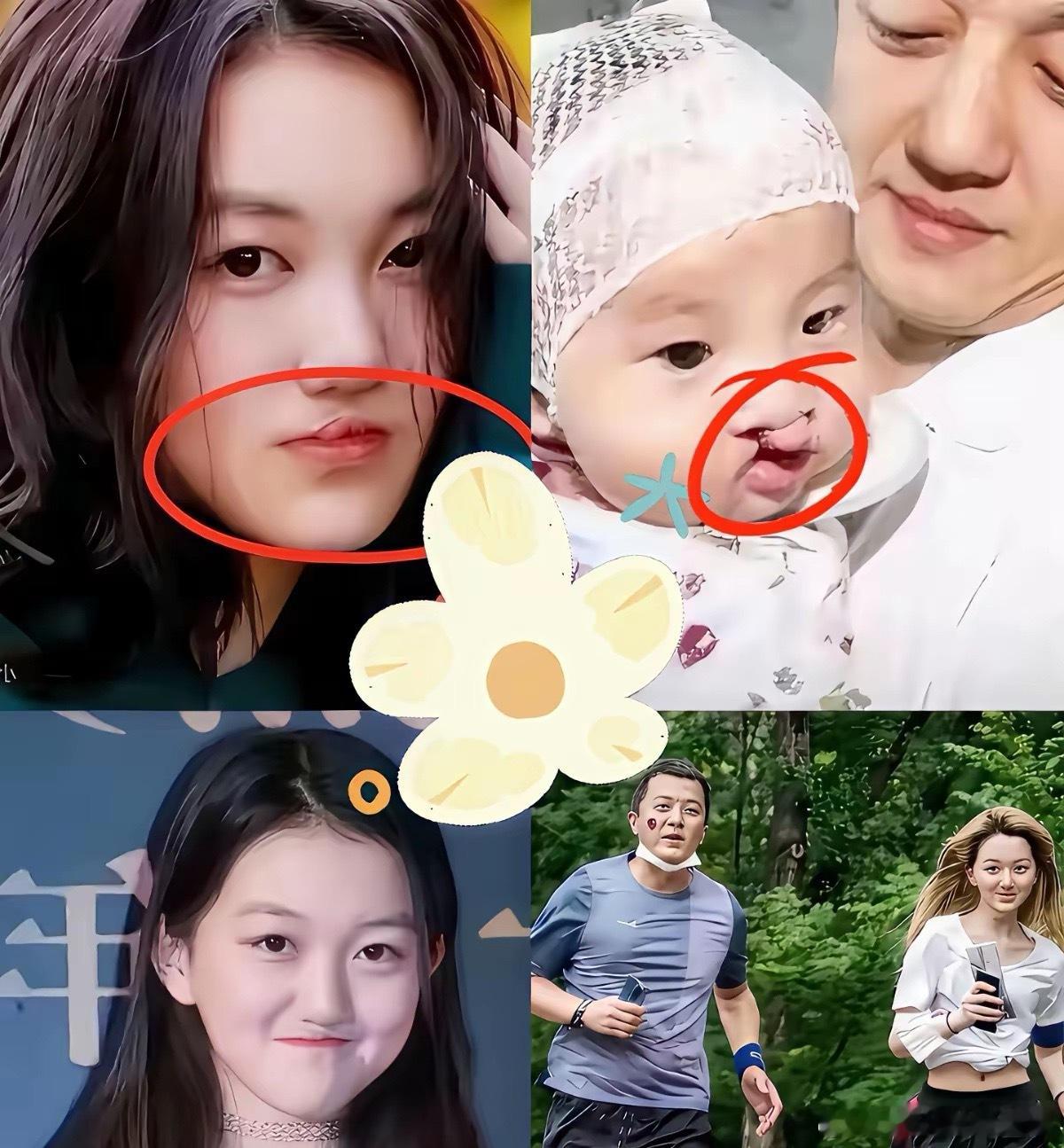 听完这笔账，我是真有点懵。为了修李嫣那张嘴，前后18年，愣是砸进去了上千万！三次