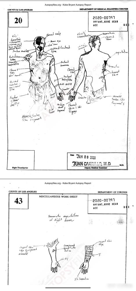 科比尸检报告。确实惨，就连科比黑粉都觉得惨。
不过科比的遗骸在坠机事故中算是比