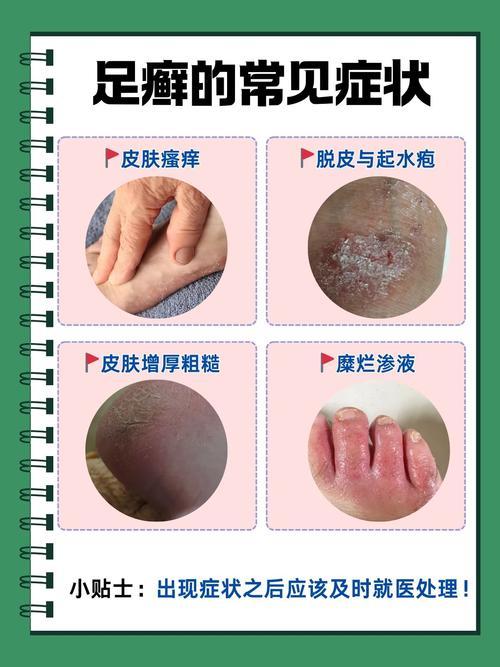 脚趾缝发白、瘙痒难耐？一文读懂原因与对策

脚趾缝出现发白、浸渍、脱皮并伴有剧烈