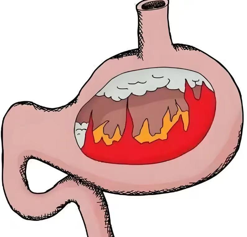 湿热缠人难摆脱？分清部位，一味中成药就能清湿热、一身轻！
很多人总被身体的“黏腻