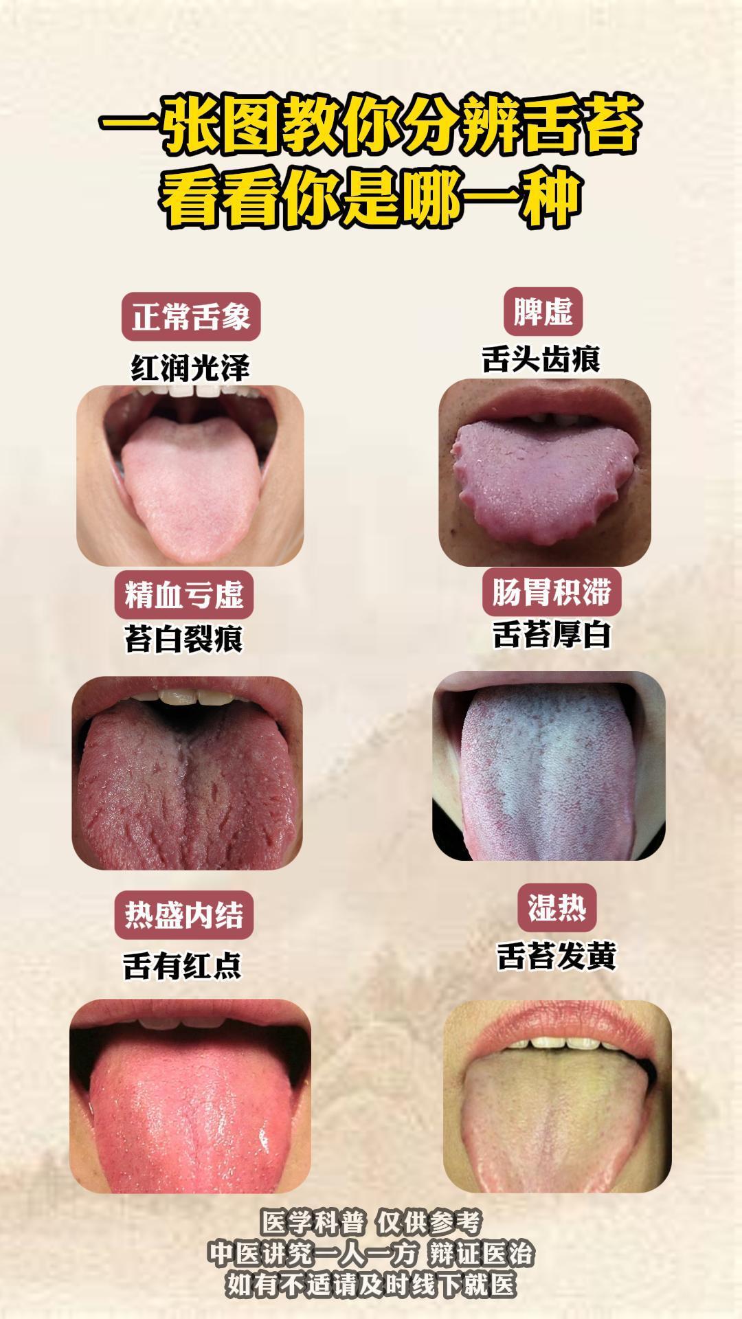 一张图教你分辨舌苔，看看你是哪一种