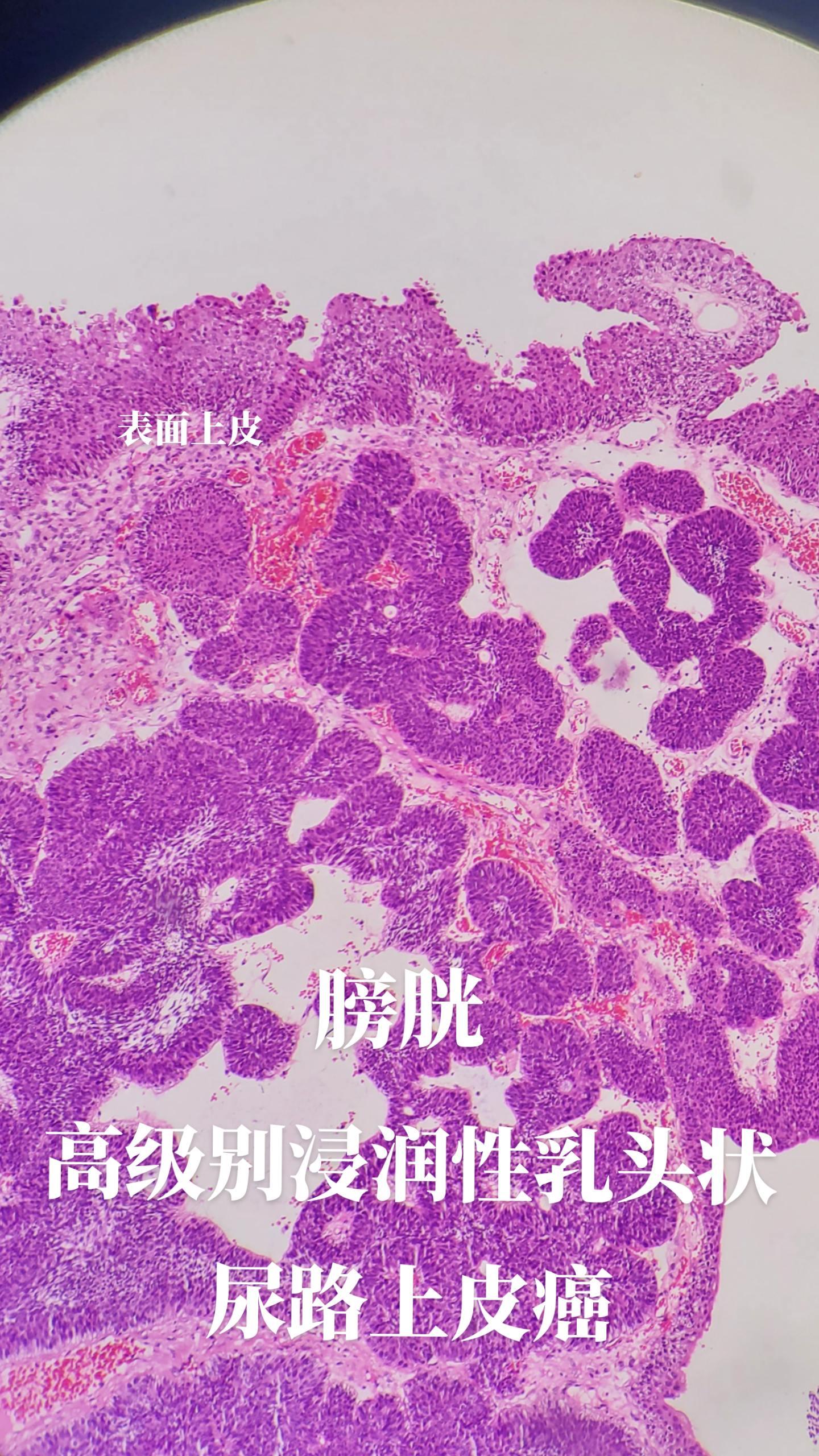 尿路上皮癌很容易复发和转移，因为肾，输尿管，膀胱都是尿路相通，而且肿瘤细胞易脱落