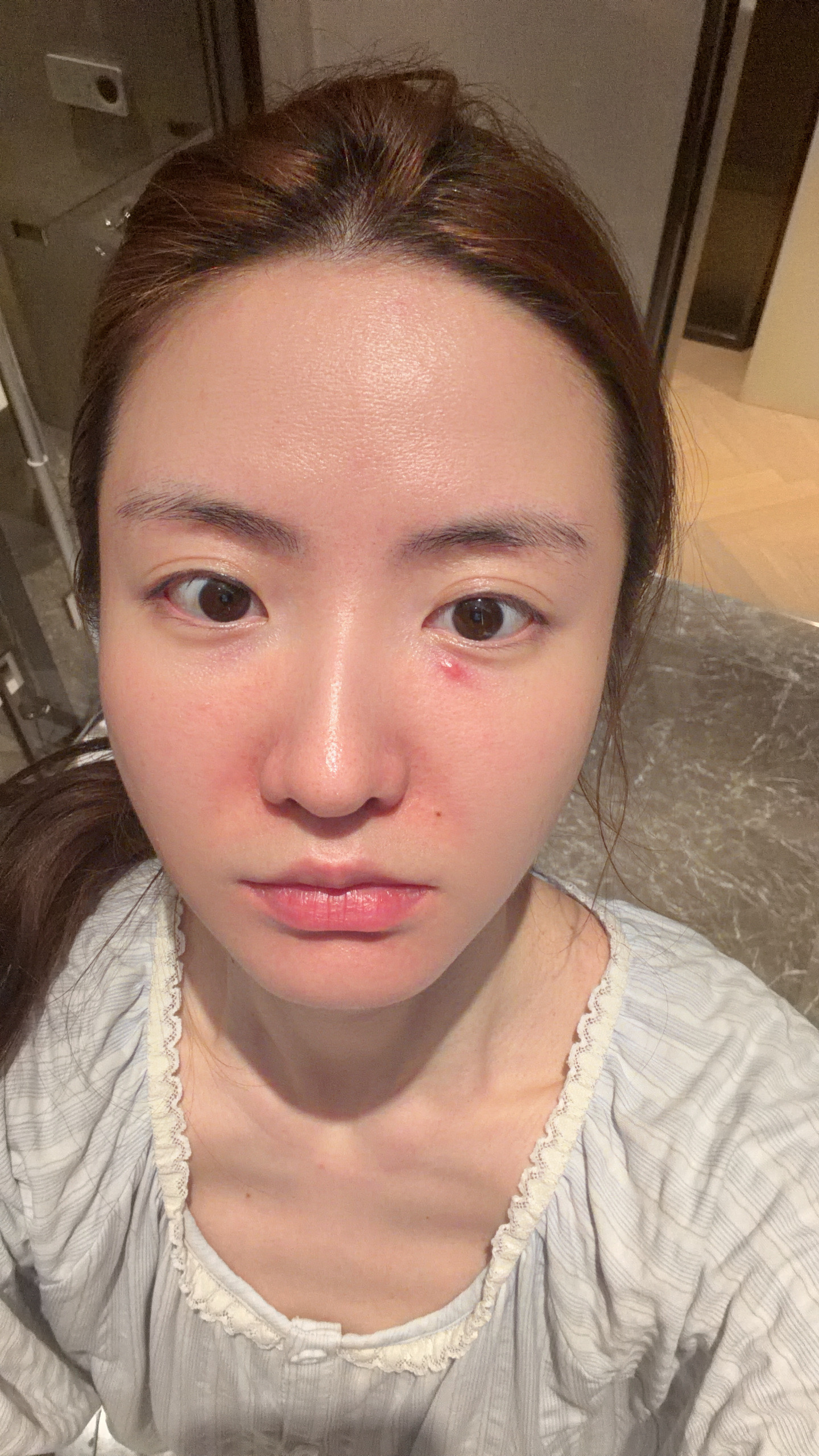 我用了一个韩国的眼贴 眼睛下面长了个痘！！！咋整啊 怎么消啊我还要拍广告