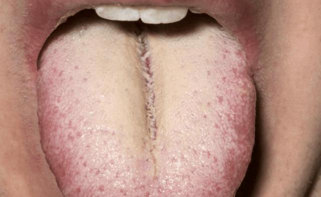 再讲最后一遍，阳虚久了，就算身体再寒，也千万别用附子理中芄这类温阳药了，主要是因