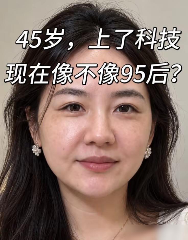 43岁，去上海做了面部提升，一个月了，大家帮我看看状态怎么样？面部提升微调。
