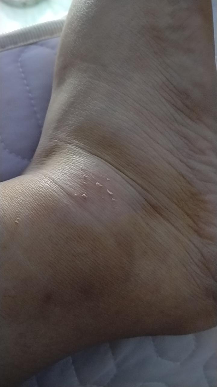 不小心摔了一跤，袜子破了一个洞，是袜子保护了我，脚踝没有流血，只是秃噜皮了，有一