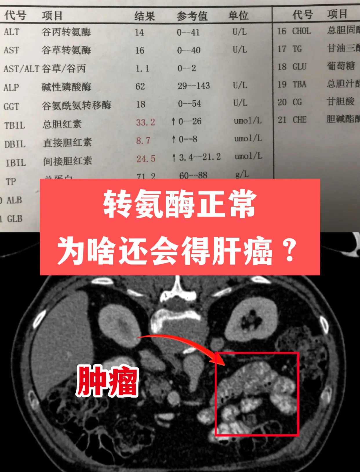 门诊上有位患者让我印象特别深，他一直拿着化验单跟我说：“教授，我转氨酶...