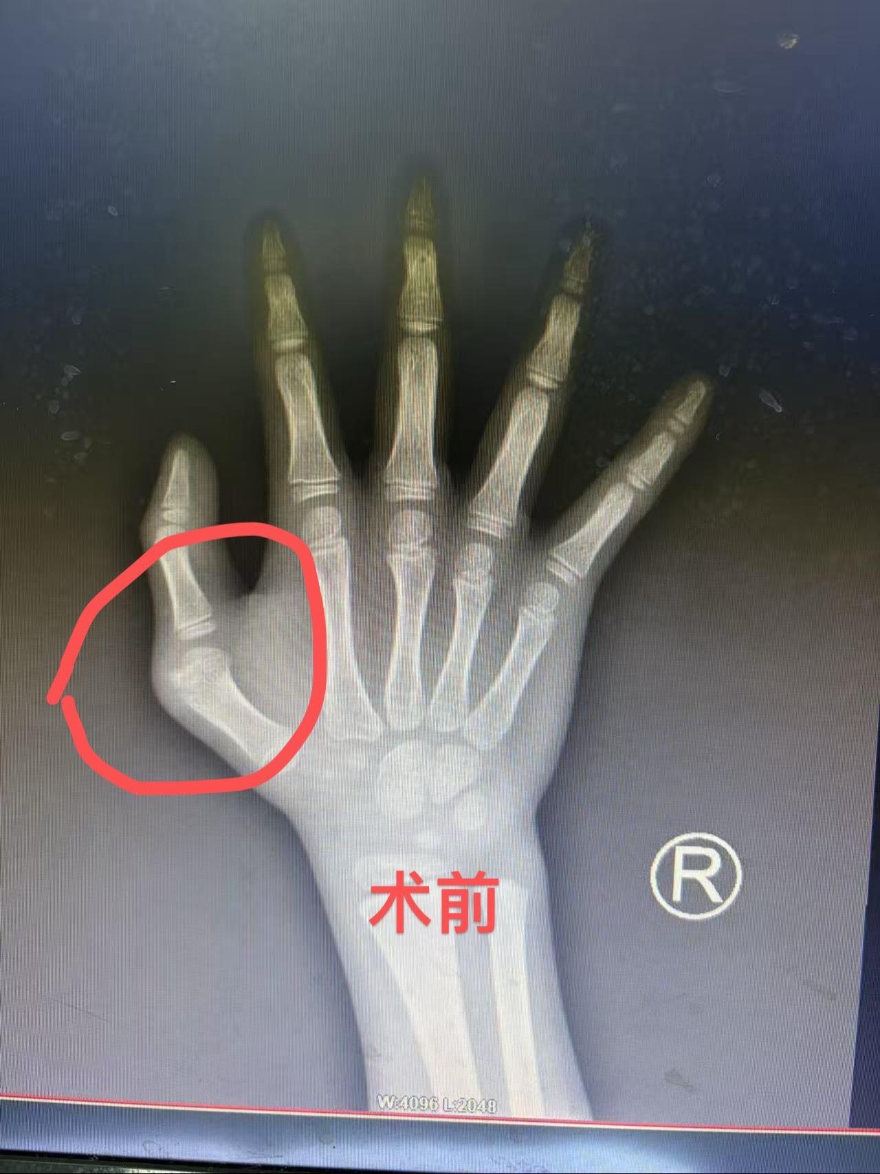 7岁小朋友，三岁时候多指切除后拇指外观和功能不佳，做完矫形术后一年复查。
