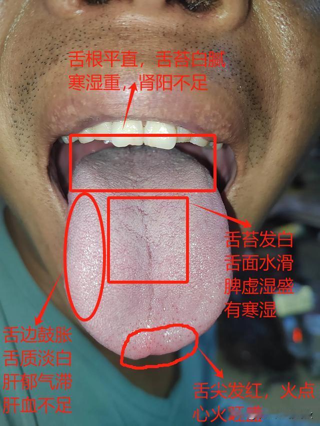 门诊3大男科典型案例，脾肾亏虚，肾阳不足，痰湿化热
中途疲软，无力，小便一趟又一