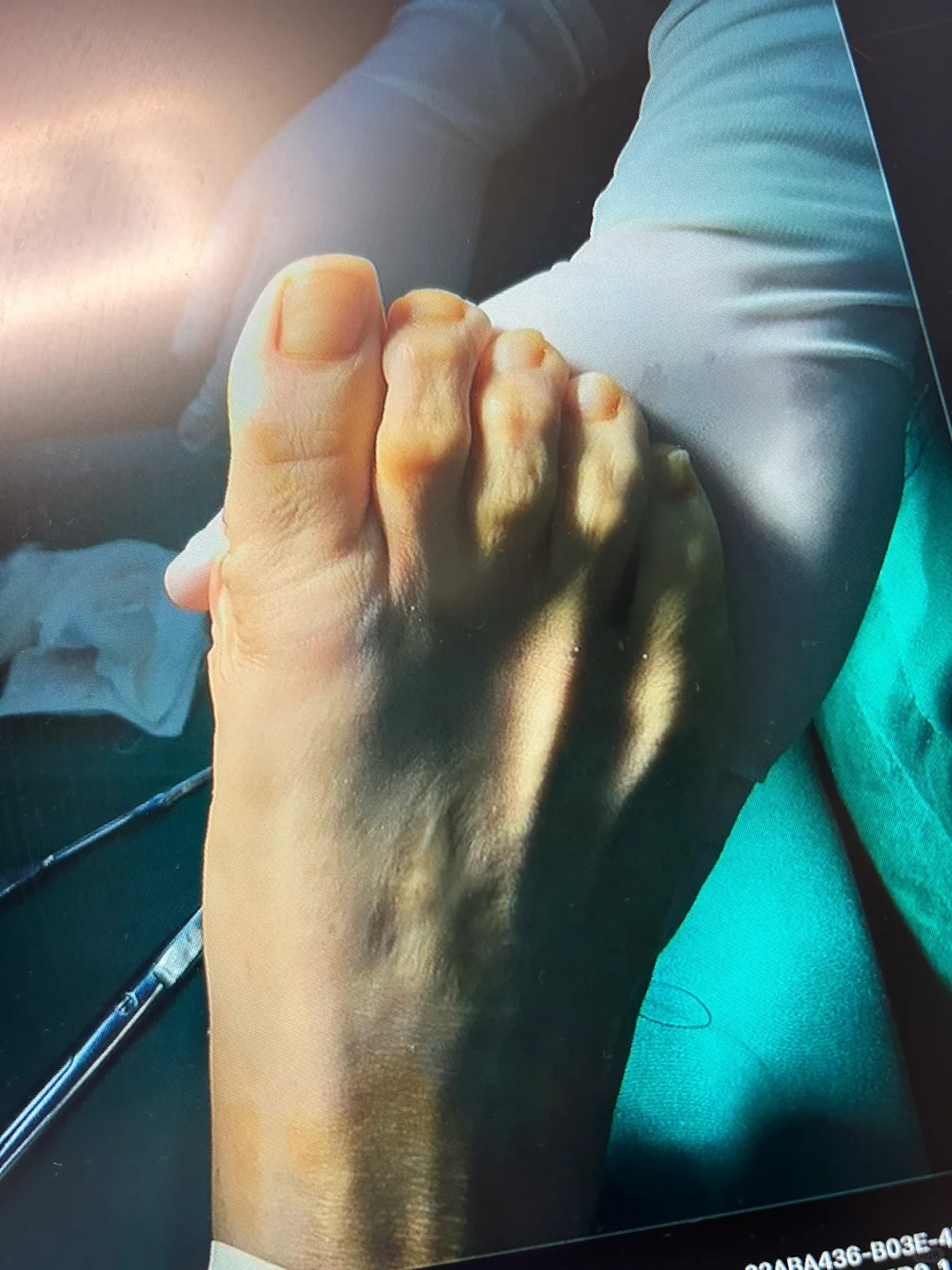 拇外翻手术的所见所得技术