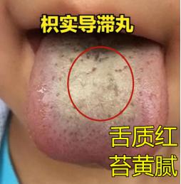 舌苔厚腻的3种舌头，用这三个药，直接把病根拔起
 
1、舌中苔厚，脾胃积食——枳