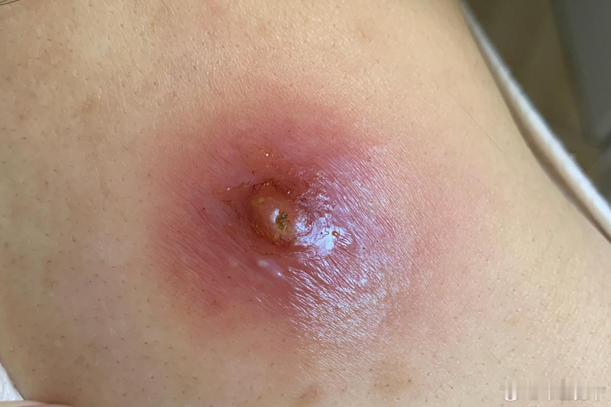 宽窄观察黄帝内经 为什么有人长个“小疖子”就死了，有人“大疮”却能活？——《灵枢