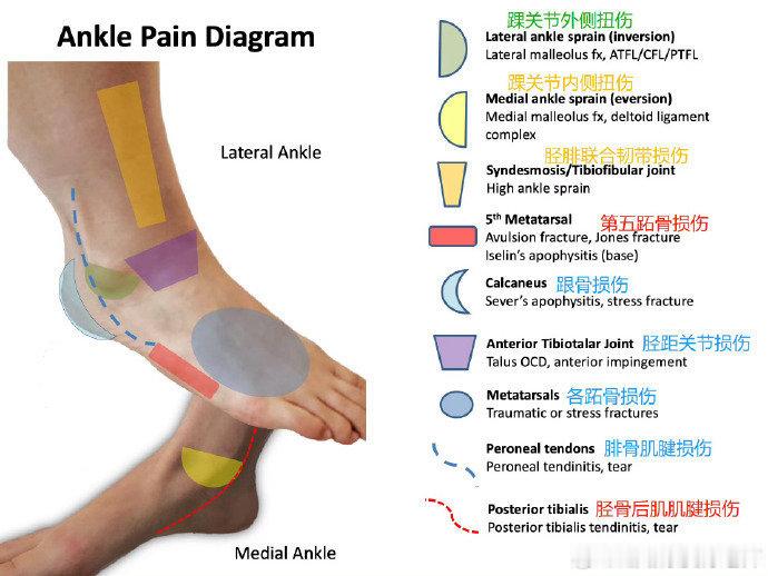 足踝疼痛盘点 接着给大家总结【足踝部不同位置疼痛】的原因：👉绿区：踝关节外侧扭