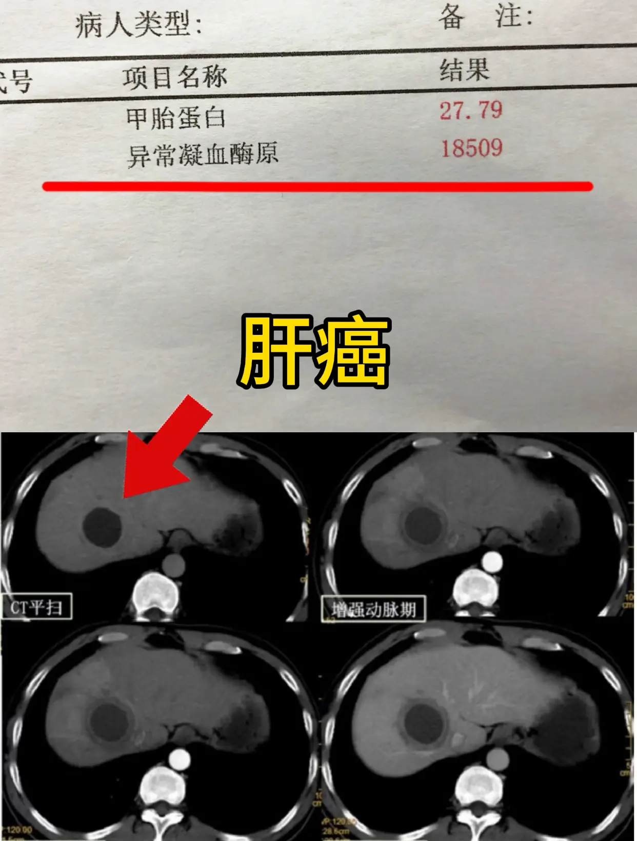 又一例！小三阳拖成肝癌，真的别再不当回事。今天门诊刚收的病人，让我心里...