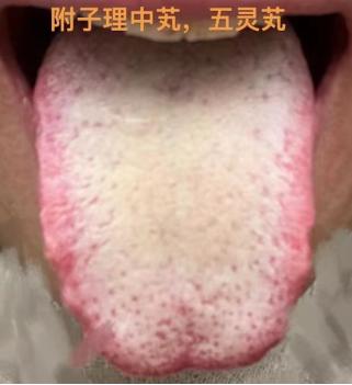 这类舌头一定要注意了，脾胃已经很虚弱了，可别再吃补药了，压根就补不进去！
 
患