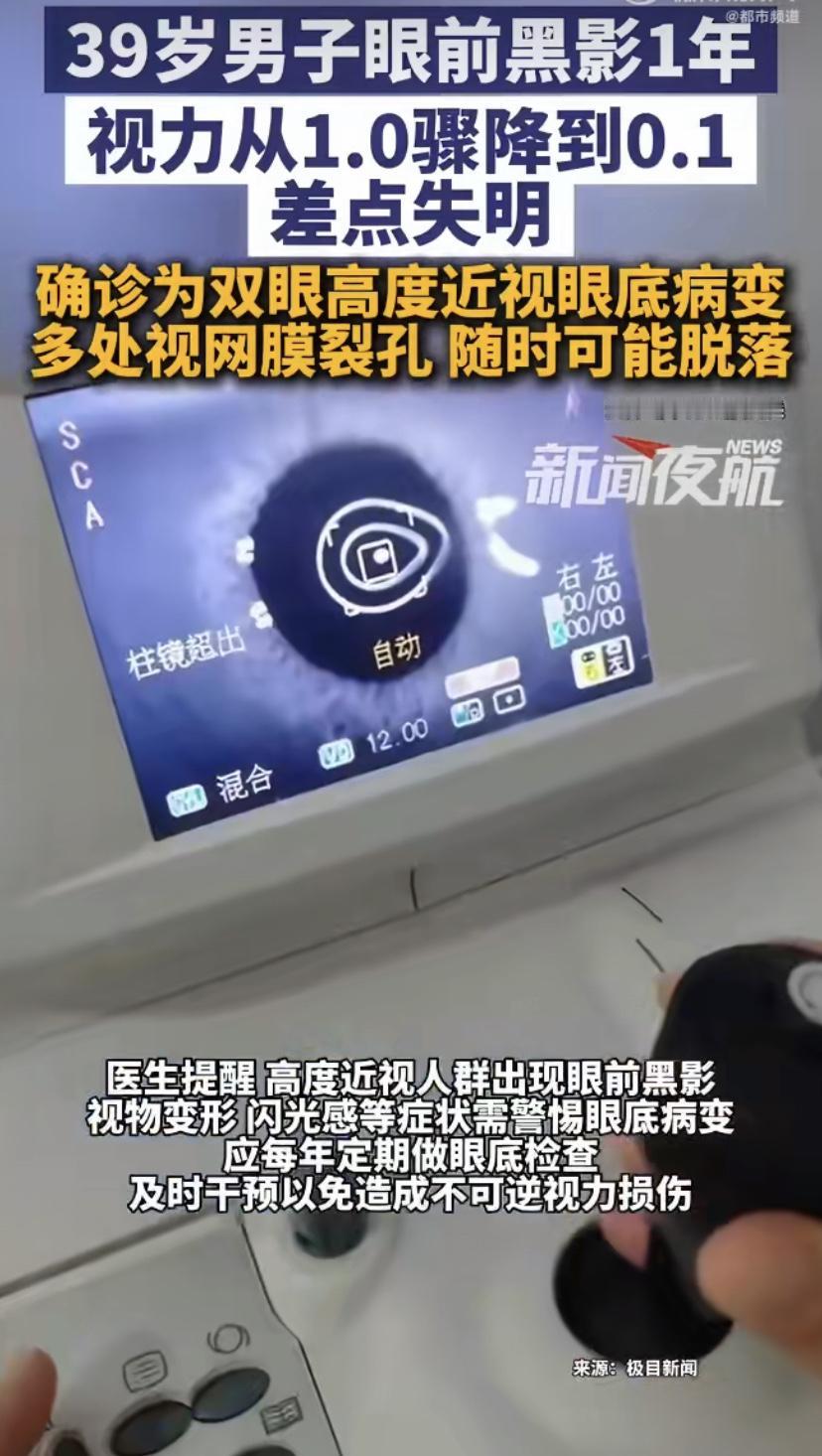 39岁男子高度近视，眼前飘黑影一年没当回事，短短几天，视力从1.0掉到0.1!