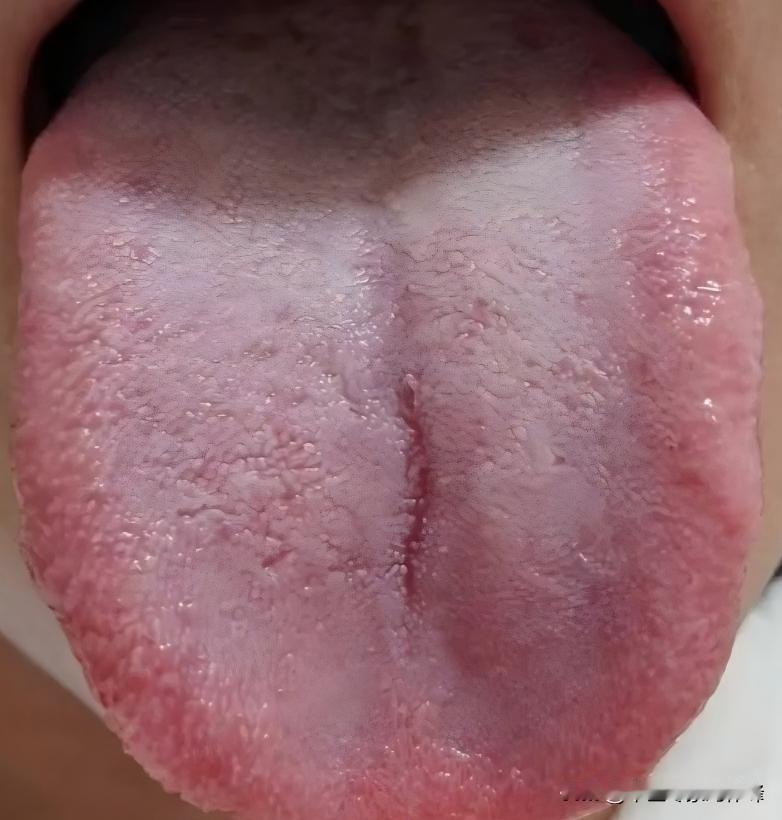 肝气郁结6个阶段的舌象
肝气郁结舌象参考:道遥丸
表现:情绪郁闷，爱生闷气，总感