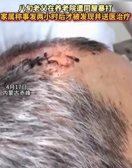 “必须严惩！”内蒙古赤峰，女子将丈夫送到养老院，几天后接丈夫，只见丈夫裤子直接裂