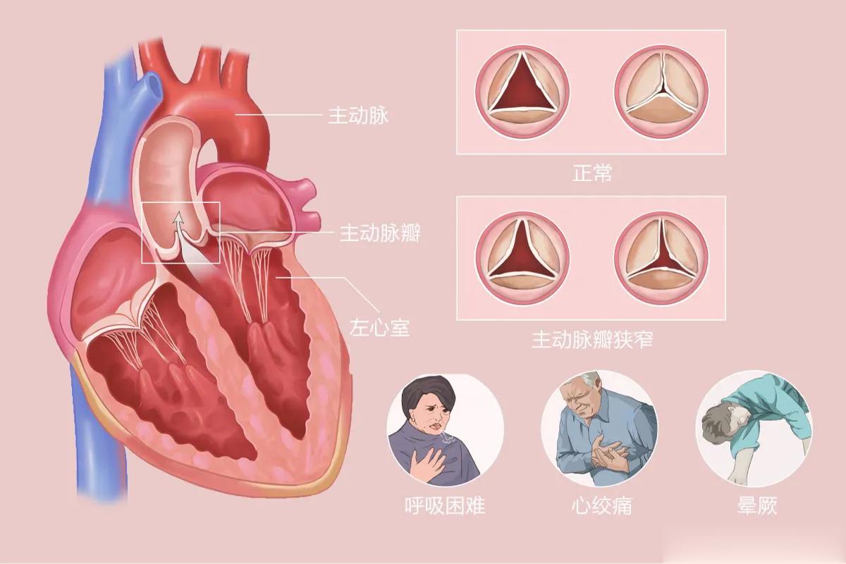 一旦确诊心脏病，这5种食物要少碰，再喜欢也要戒掉！一旦确诊心脏病，饮食便成为了治