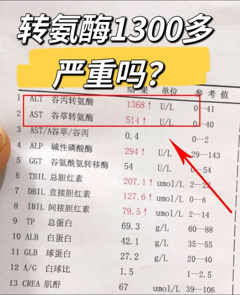 转氨酶1300多严重吗?转氨酶1300多确实是比较高的水平了，必须高度...