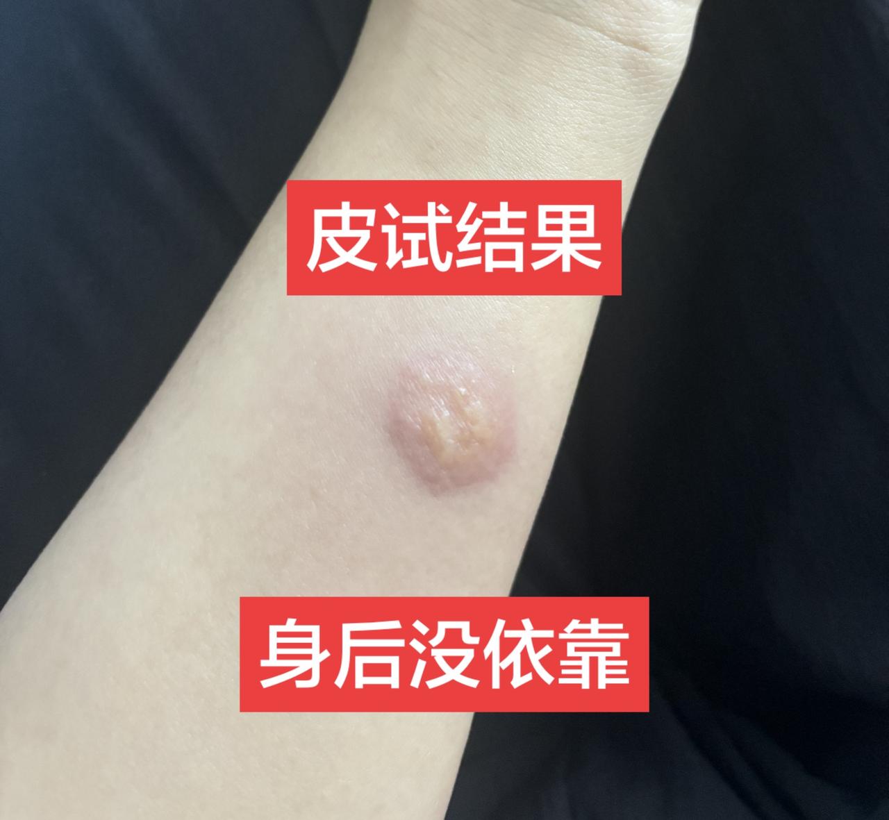 不知道你们确诊后有没有哭，我哭了，因为我身后没有依靠，不知道怎么上班，一天去20