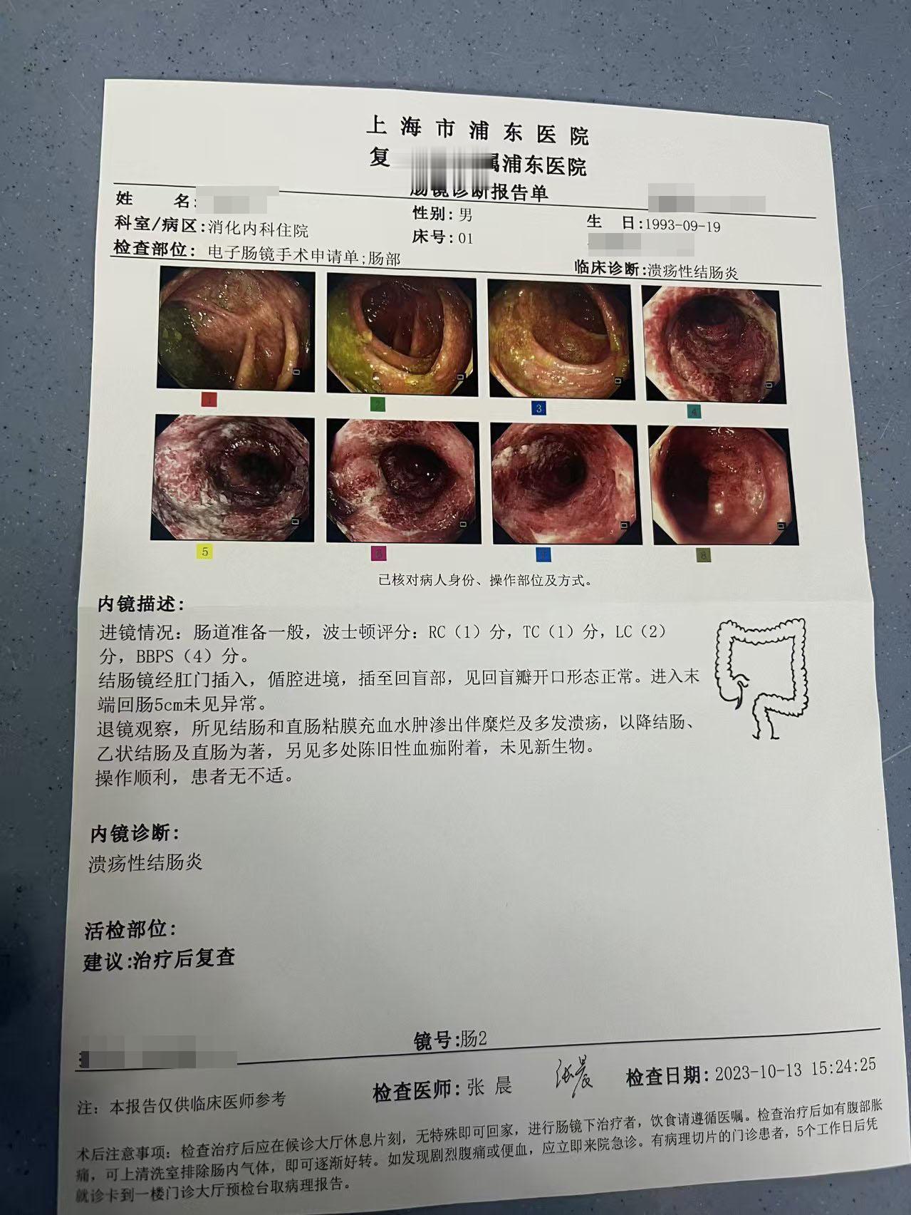 这位是溃疡性结肠炎17年的患者，反反复复脓血便，2023年加重（肠镜如...