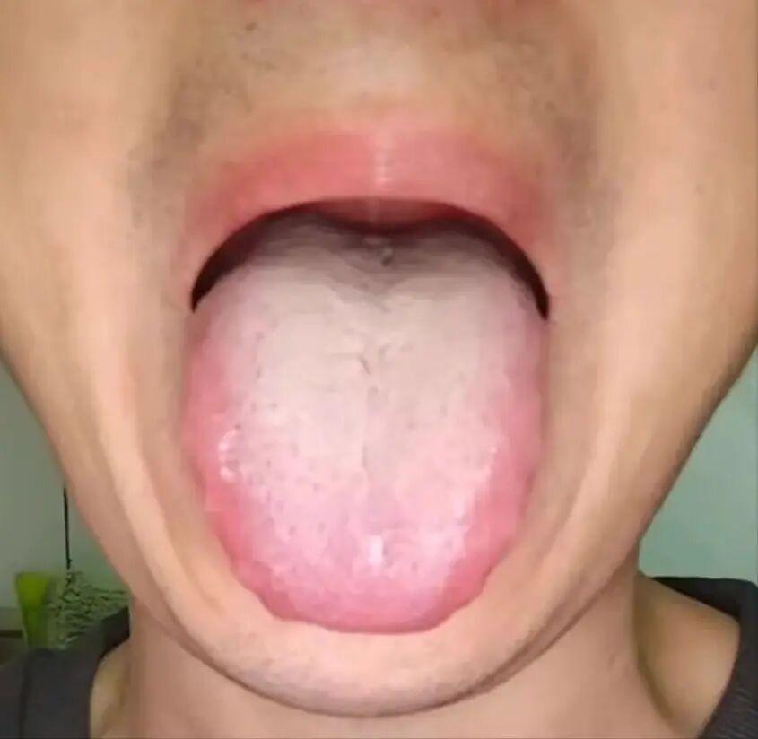 从舌象看健康：肝郁化火与阳虚寒湿如何影响生活？
患者反映，自己虽被诊断为肝郁和阳