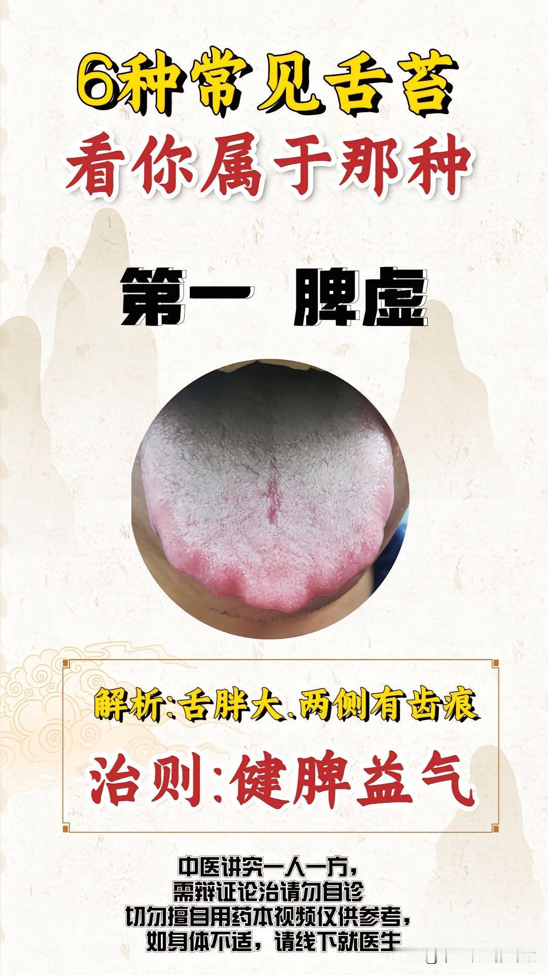 门诊最常见的6大舌象，涵盖90%的患者
只需简单对症，就能快速分辨身体情况
对症