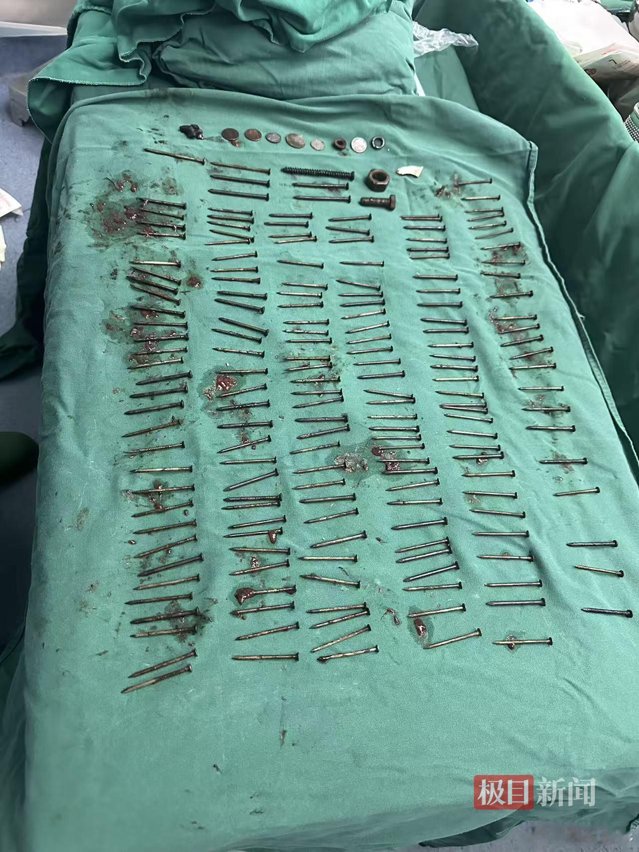 云南一男子胃中取出180颗铁钉80颗铁钉堆积胃部，源于无法自控的精神疾病，锋利金