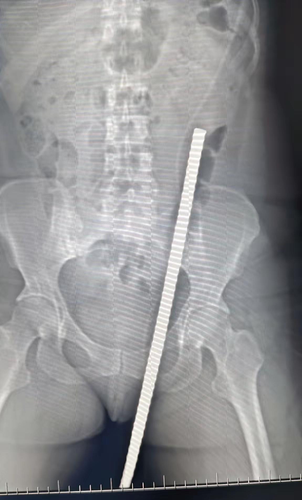 女性，47岁，工地干活，从楼梯上摔下，钢筋穿入会阴部，从皮肤穿出，不幸中的幸运，