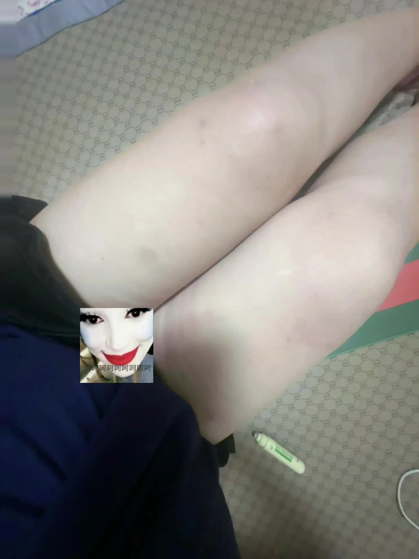 这是多少个蚊子包啊