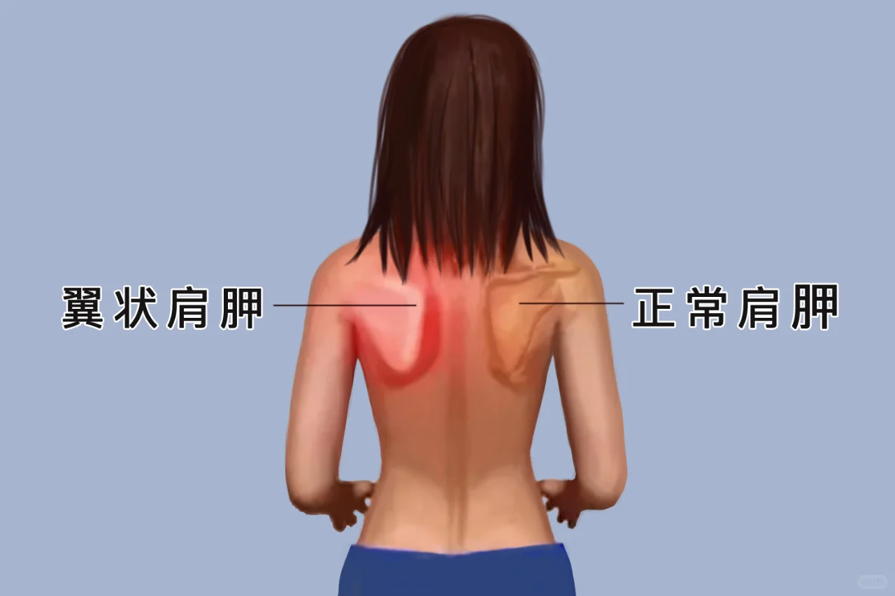 翼状肩和正常肩膀图片