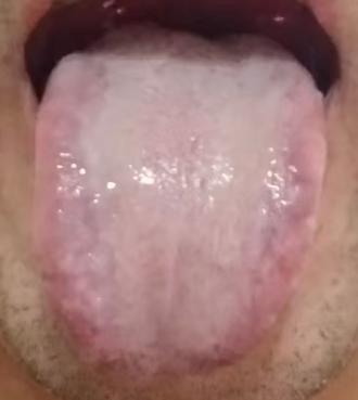 脾胃亏虚伴随上热下寒，如何调理宗筋问题？






男士如果出现功能方面的困扰