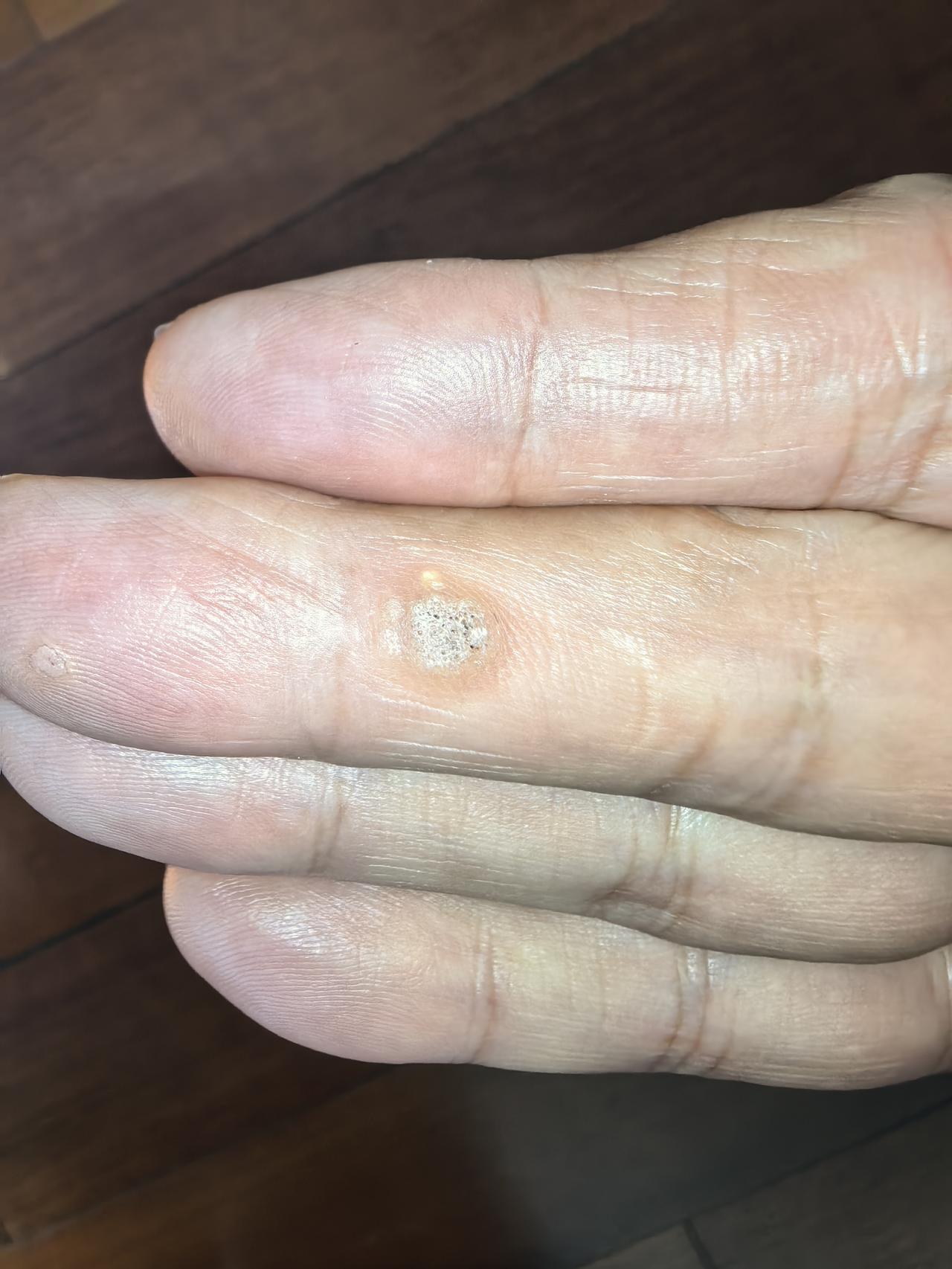 中指内侧长出了这玩意儿，已经很长时间了。不疼不痒，中间突起的皮肤在坏死，周边在慢