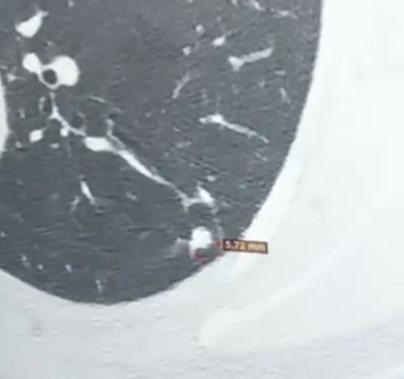 周一门诊，一位34岁的女士来复查肺结节。她说，其实半年前就挂过我的号，可到了那天