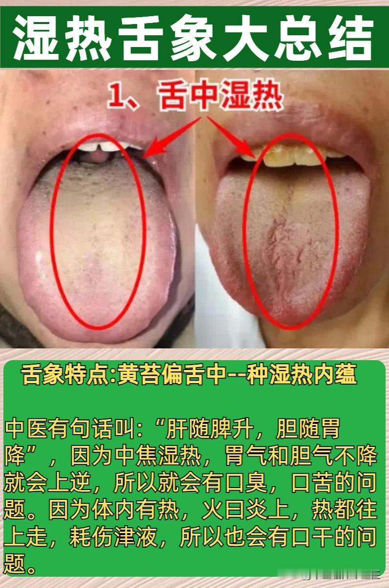 三种湿热舌象大总结，看看你是哪一种？

1，脾胃湿热

2，下焦湿热

3，肝胆