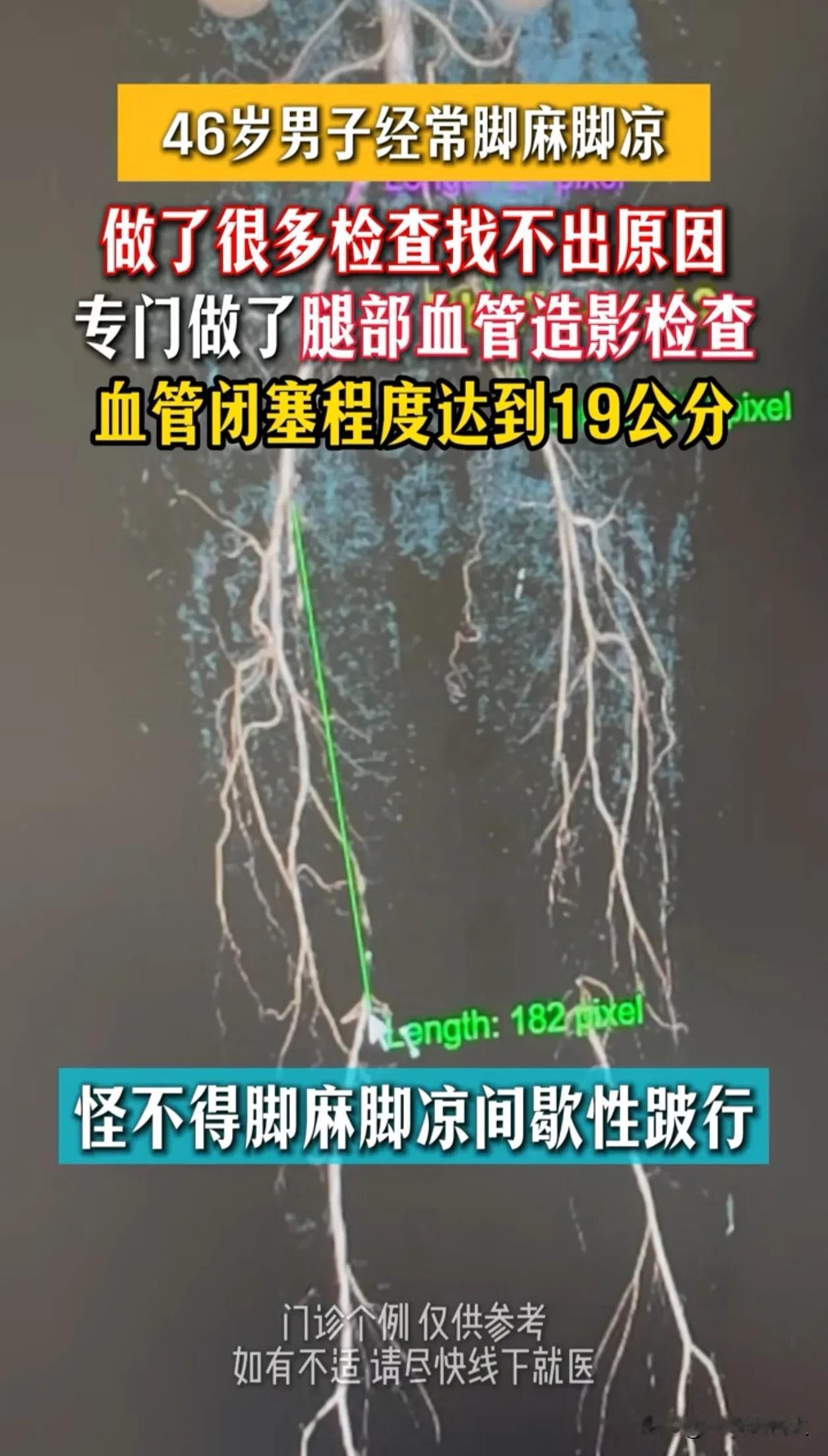 46岁男子，不抽烟不喝酒，就是脚麻脚凉走不动道，查遍腰椎没毛病，没想到问题竟出在