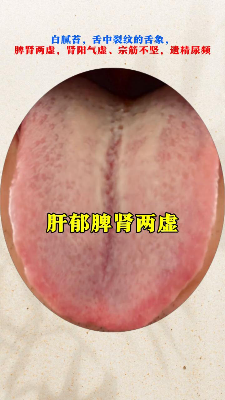 这种舌头凹陷裂纹深，厚腻苔，舌质淡白，舌边鼓胀，肝郁，脾肾两虚，肾阳气虚问题可真