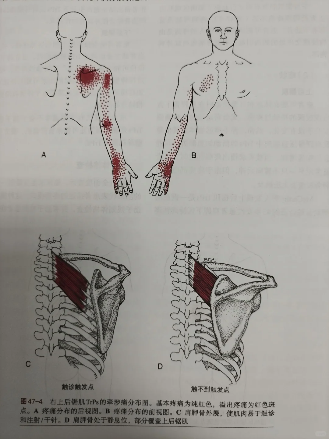 上后锯肌和下后锯肌牵涉T表现