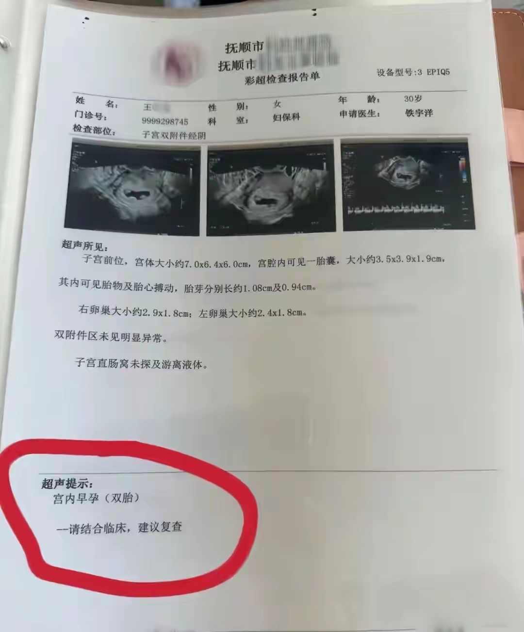 解释不清了！辽宁抚顺，一女子怀孕以后，进行了4次产检，每次检查都发现多出一个胎儿