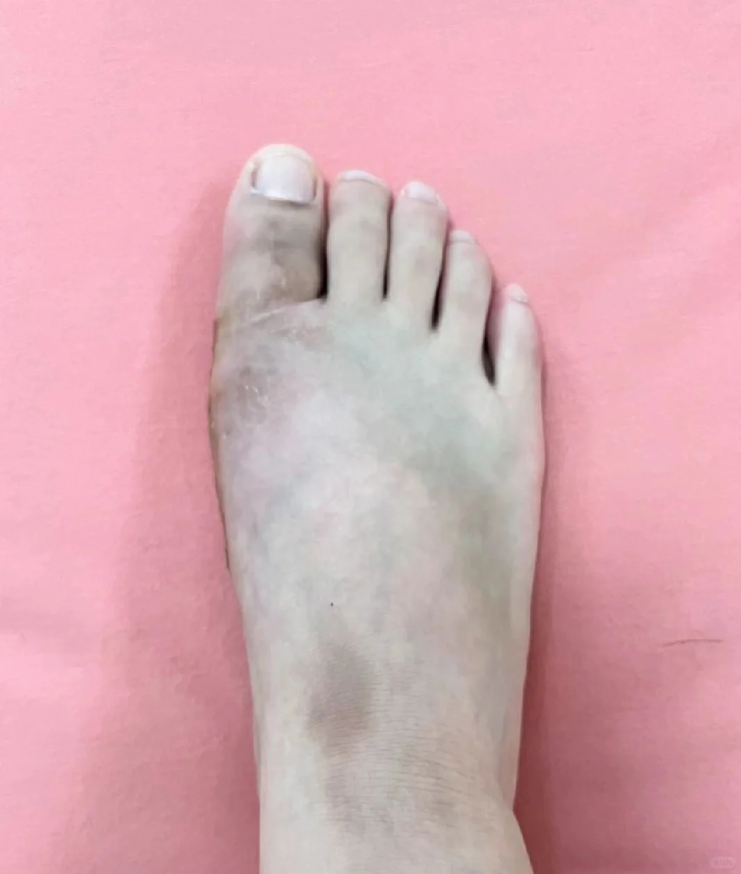 拇外翻手术的”所见所得”技术