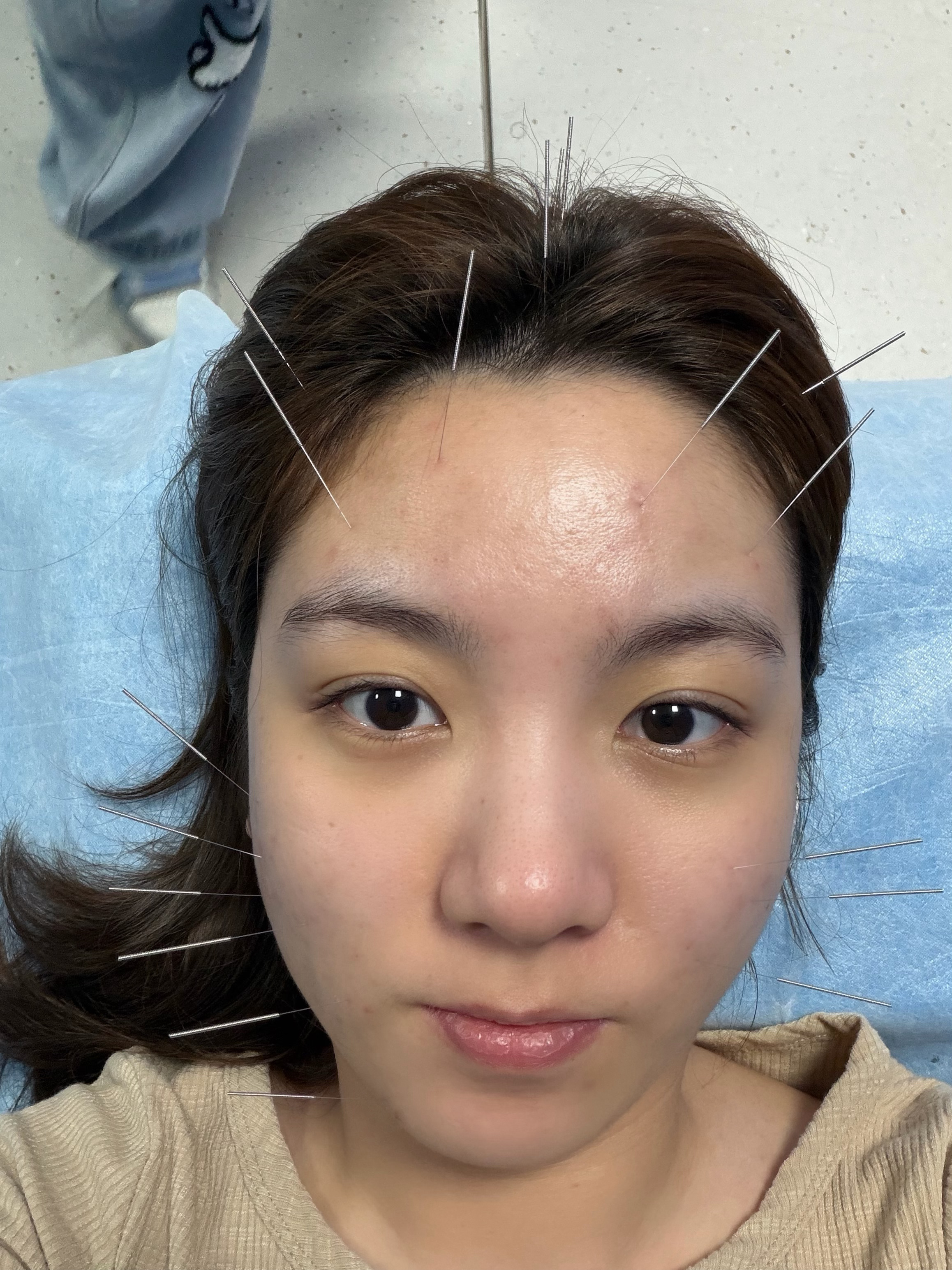 宇宙无敌最好的针灸医生👨🏻‍⚕️梁大夫！扎我痘印还治我失眠[祈祷][祈祷][