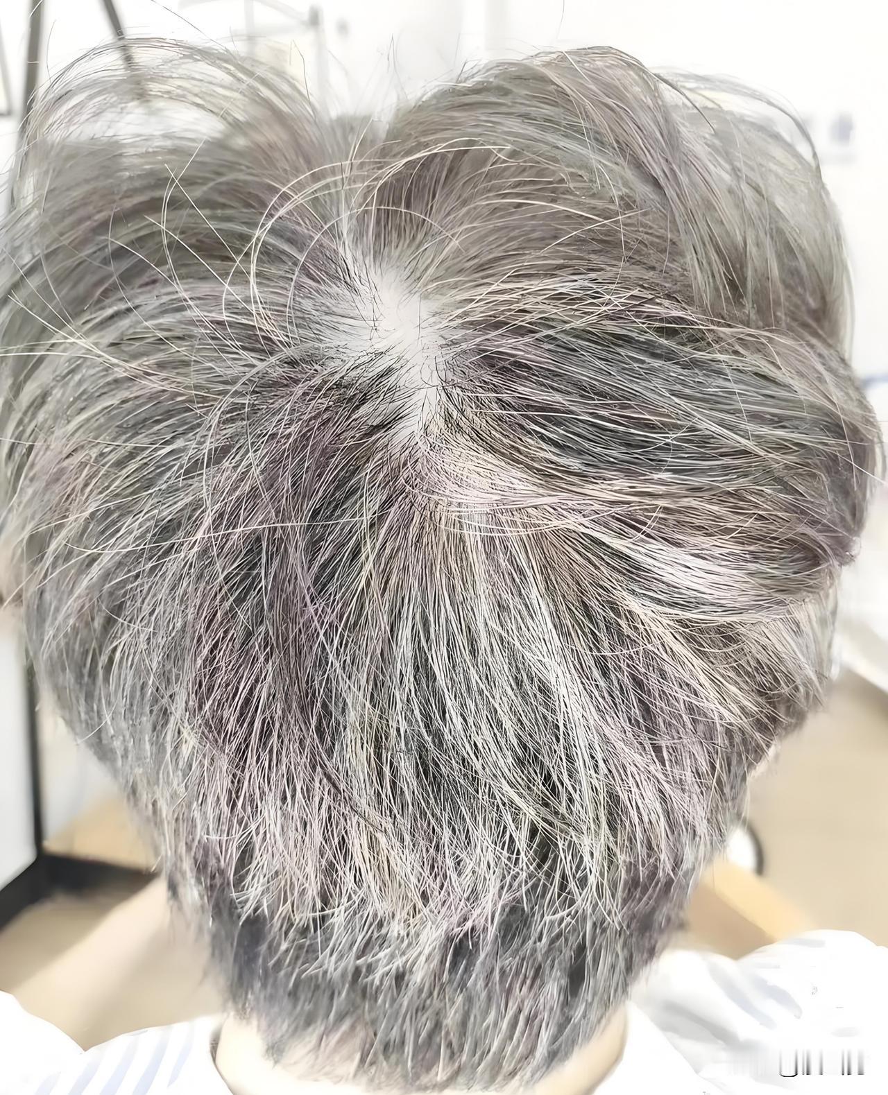 依稀记得，我的白发20出头就开始有了。不是夹杂在黑发中，而是成铜钱一块出现。曾看