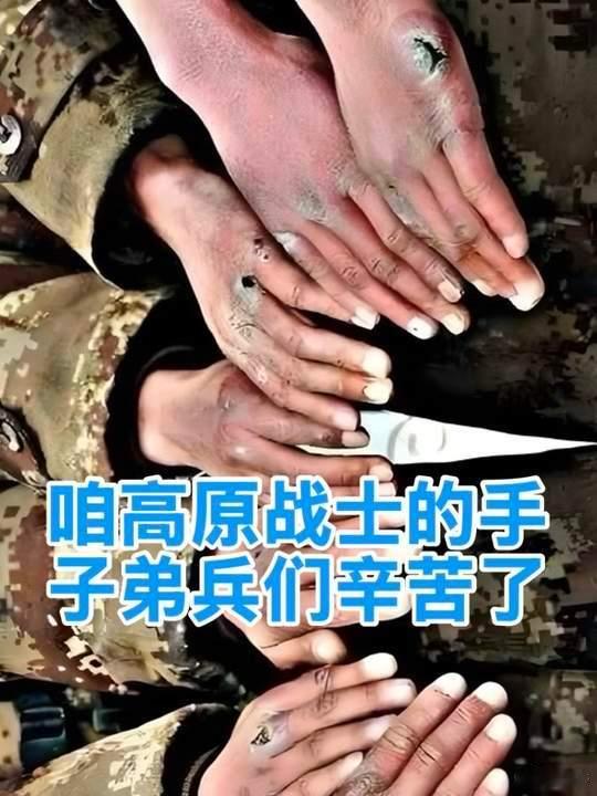 咱高原战士的手、子弟兵们辛苦了。🫡🙏边防战士的冻伤让人心疼 ​​​
