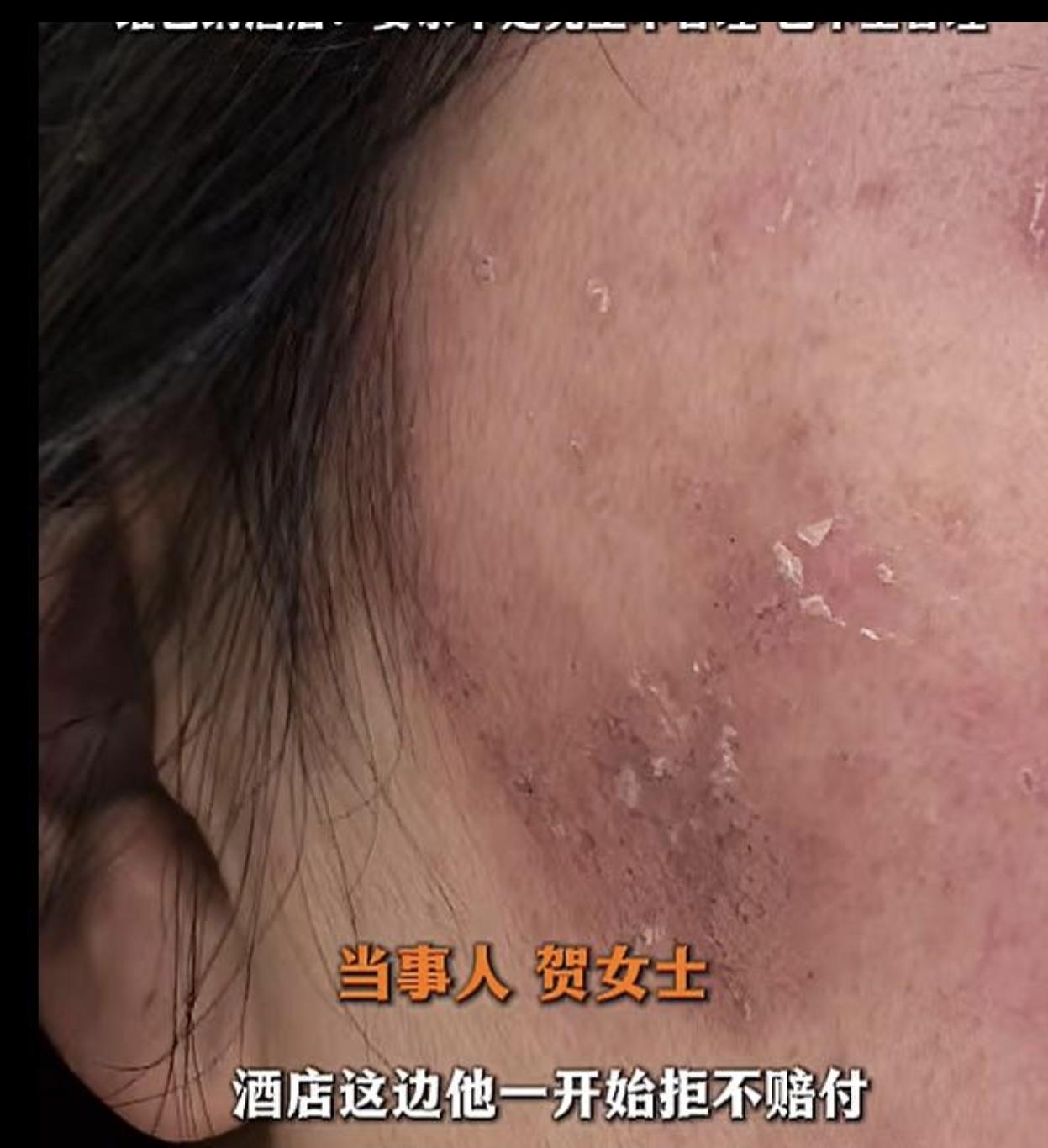 湖南怀化，一女子在酒店睡了一觉，没想到第二天早上女子醒来的时候，她的身上又红又痒