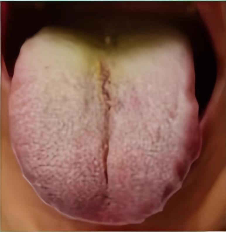 舌面上这么长的一条裂纹，身体都不知道成啥样了，不难受就怪了！

我们来看这位朋友