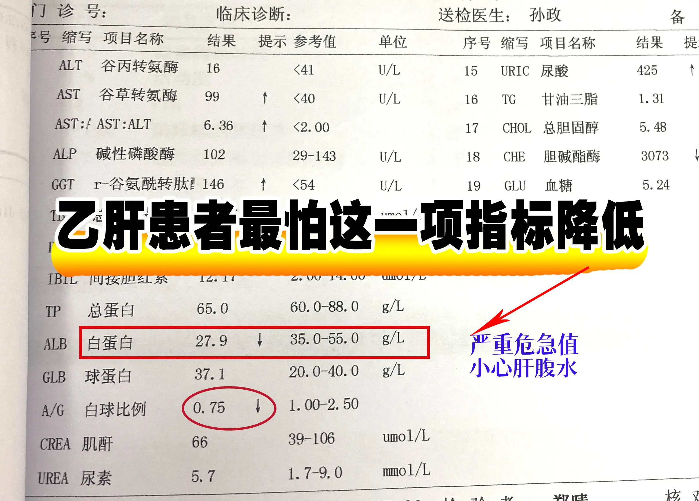 乙肝患者最怕这一项指标降低  乙肝多年未治疗，也不检查，生活我行我素...