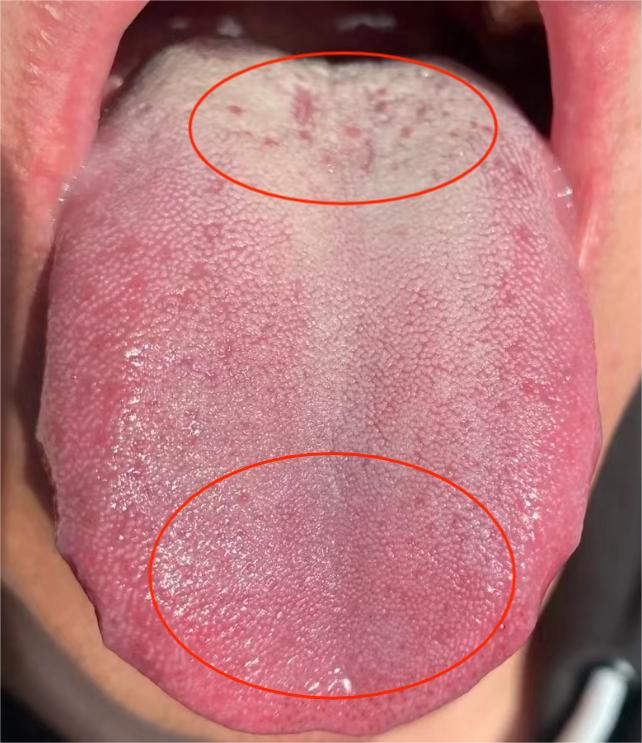 典型的上热下寒舌象  交代快  10秒都难以维持  但又容易胡思乱想

 
患者