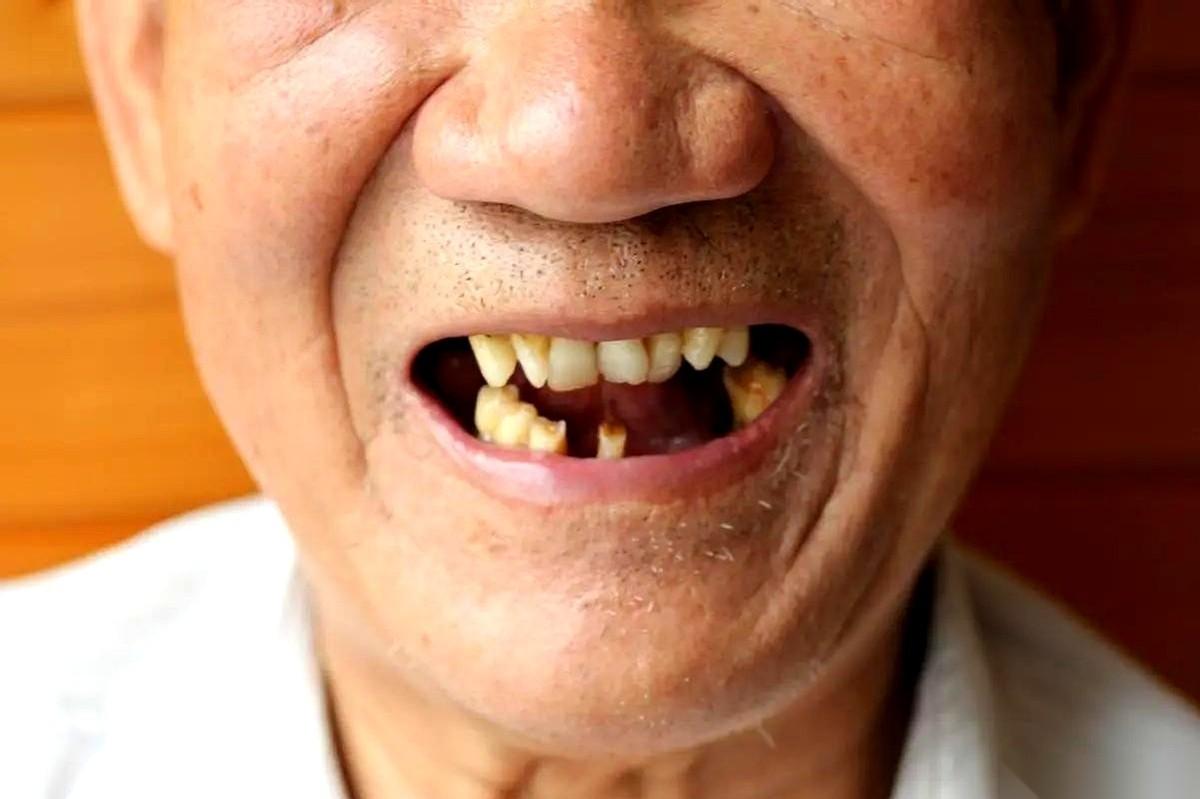 很多人觉得牙齿掉了能补，坏了能镶，但这其实是身体在发出最后的“最后通牒”。
关于